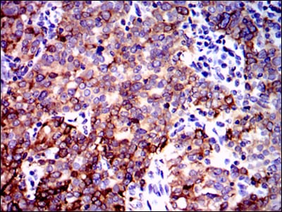 Figure 2: Immunohistochemical analysis of paraffin-embedded cervical cancer tissues using PPP2R4 mouse mAb with DAB staining.