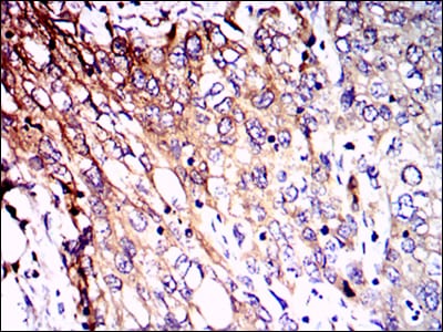 Figure 3: Immunohistochemical analysis of paraffin-embedded lung cancer tissues using NEFL mouse mAb with DAB staining.