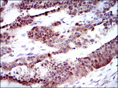 Figure 2: Immunohistochemical analysis of paraffin-embedded ovarian cancer tissues using CYP1A1 mouse mAb with DAB staining.