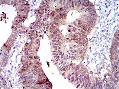 Figure 3: Immunohistochemical analysis of paraffin-embedded rectum cancer tissues using CYP1A1 mouse mAb with DAB staining.