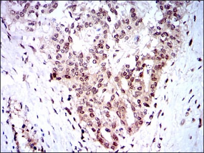 Figure 3: Immunohistochemical analysis of paraffin-embedded ovarian cancer tissues using SKP1 mouse mAb with DAB staining.