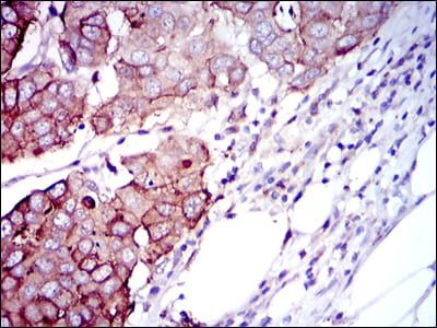 Figure 2: Immunohistochemical analysis of paraffin-embedded breast cancer tissues using RPS6KB1 mouse mAb with DAB staining.