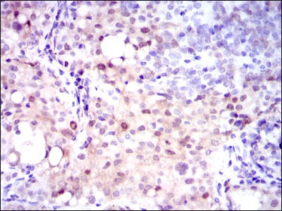 Figure 3: Immunohistochemical analysis of paraffin-embedded cervical cancer tissues using ASS1 mouse mAb with DAB staining.