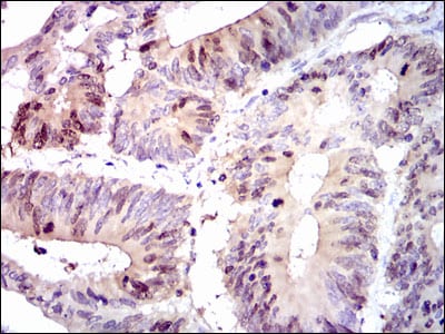 Figure5: Immunohistochemical analysis of paraffin-embedded colon cancer tissues using PBK mouse mAb with DAB staining.