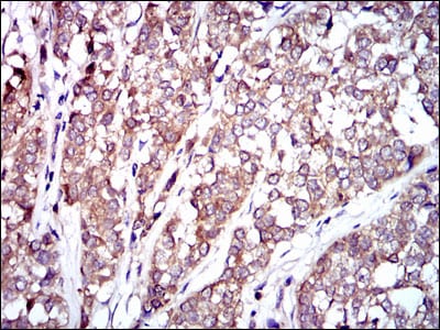 Figure 3: Immunohistochemical analysis of paraffin-embedded bladder cancer tissues using RAF1 mouse mAb with DAB staining.