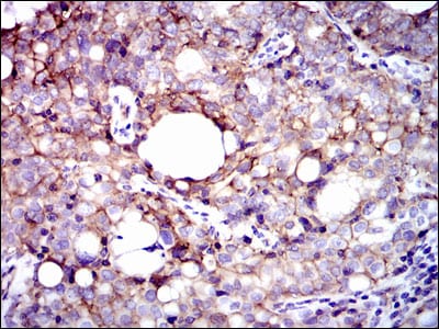 Figure 4: Immunohistochemical analysis of paraffin-embedded cervical cancer tissues using ITGB1 mouse mAb with DAB staining.