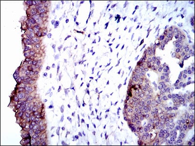 Figure 3: Immunohistochemical analysis of paraffin-embedded ovarian cancer tissues using ALPL mouse mAb with DAB staining.