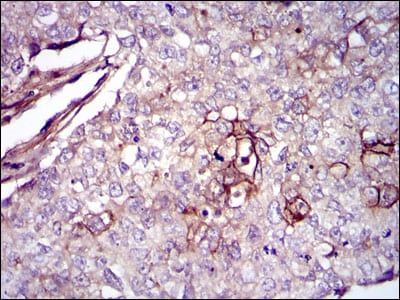 Figure 3: Immunohistochemical analysis of paraffin-embedded lung cancer tissues using FN1 mouse mAb with DAB staining.