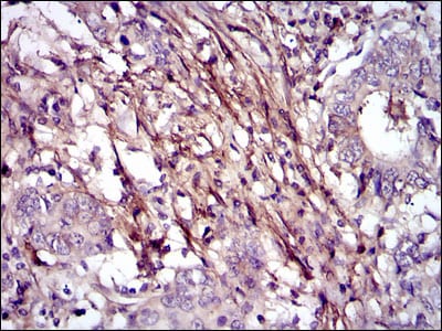 Figure 4: Immunohistochemical analysis of paraffin-embedded stomach cancer tissues using FN1 mouse mAb with DAB staining.