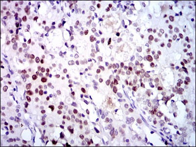 Figure 3: Immunohistochemical analysis of paraffin-embedded cervical cancer tissues using CDK2 mouse mAb with DAB staining.