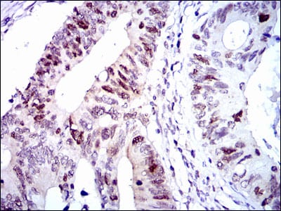 Figure 4: Immunohistochemical analysis of paraffin-embedded colon cancer tissues using CDK2 mouse mAb with DAB staining.