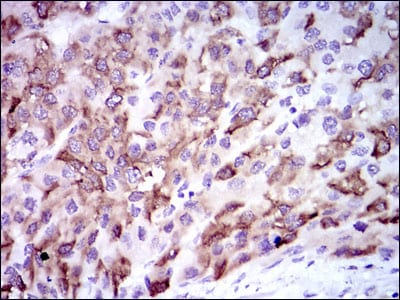 Figure 3: Immunohistochemical analysis of paraffin-embedded liver cancer tissues using CYP3A4 mouse mAb with DAB staining.