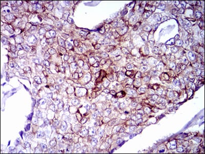 Figure 3: Immunohistochemical analysis of paraffin-embedded breast cancer tissues using CK5 mouse mAb with DAB staining.