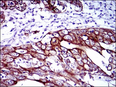 Figure 4: Immunohistochemical analysis of paraffin-embedded stomach cancer tissues using CK5 mouse mAb with DAB staining.