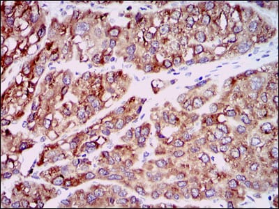 Figure 3: Immunohistochemical analysis of paraffin-embedded liver cancer tissues using CCL2 mouse mAb with DAB staining.