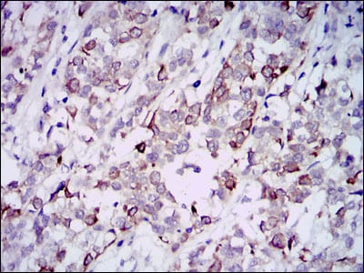 Figure 3: Immunohistochemical analysis of paraffin-embedded bladder cancer tissues using GAB1 mouse mAb with DAB staining.