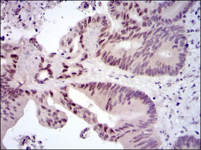 Figure 3: Immunohistochemical analysis of paraffin-embedded colon cancer tissues using FOS mouse mAb with DAB staining.