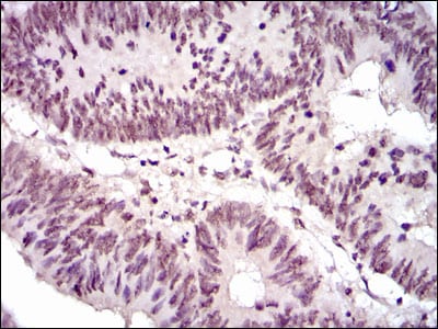 Figure 3: Immunohistochemical analysis of paraffin-embedded rectum cancer tissues using NCK1 mouse mAb with DAB staining.