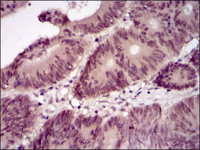 Figure 2: Immunohistochemical analysis of paraffin-embedded colon cancer tissues using Lplunc1 mouse mAb with DAB staining.