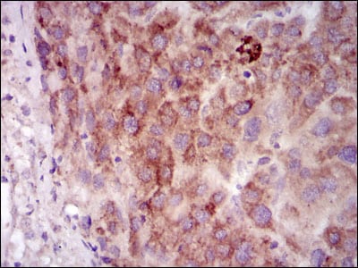 Figure 2: Immunohistochemical analysis of paraffin-embedded liver cancer tissues using PRKACG mouse mAb with DAB staining.