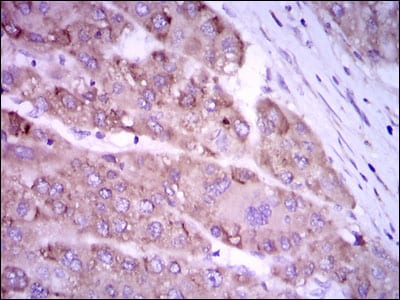 Figure 3: Immunohistochemical analysis of paraffin-embedded liver cancer tissues using NOS2 mouse mAb with DAB staining.