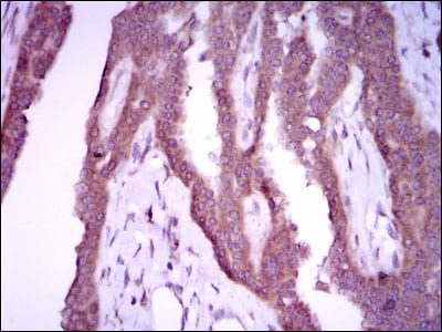 Figure 4: Immunohistochemical analysis of paraffin-embedded breast cancer tissues using NOS2 mouse mAb with DAB staining.