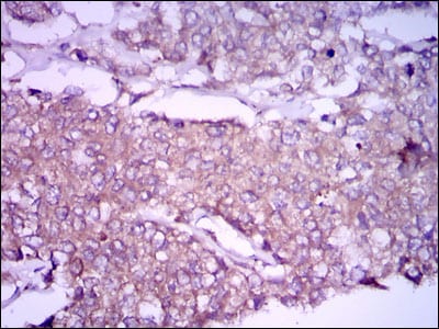 Figure 4: Immunohistochemical analysis of paraffin-embedded breast cancer tissues using GPC3 mouse mAb with DAB staining.