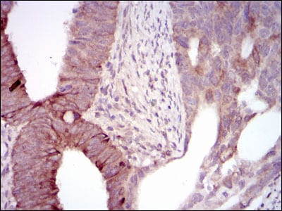 Figure 2: Immunohistochemical analysis of paraffin-embedded rectum cancer tissues using MELK mouse mAb with DAB staining.