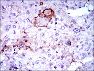 Figure 2: Immunohistochemical analysis of paraffin-embedded liver cancer tissues using LPA mouse mAb with DAB staining.