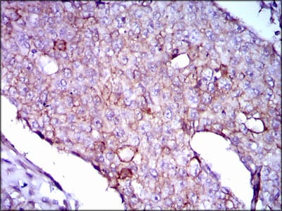 Figure 3: Immunohistochemical analysis of paraffin-embedded breast cancer tissues using LPA mouse mAb with DAB staining.