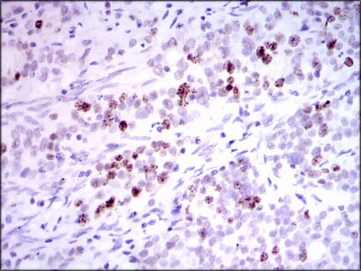 Figure 3: Immunohistochemical analysis of paraffin-embedded cervical cancer tissues using INCENP mouse mAb with DAB staining.