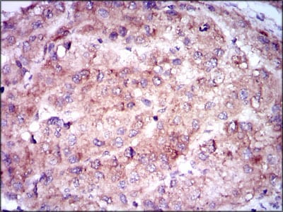 Figure 5: Immunohistochemical analysis of paraffin-embedded liver cancer tissues using ENO2 mouse mAb with DAB staining.