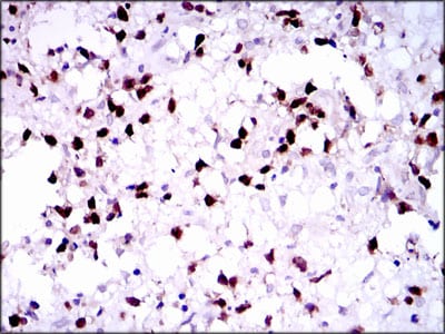 Figure 2: Immunohistochemical analysis of paraffin-embedded brain tumors tissues using PAX5 mouse mAb with DAB staining.