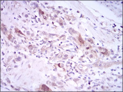 Figure 4: Immunohistochemical analysis of paraffin-embedded stomach cancer tissues using PLK1 mouse mAb with DAB staining.