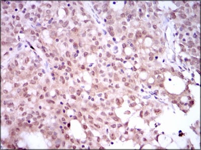 Figure 4: Immunohistochemical analysis of paraffin-embedded cervical cancer tissues using SRY mouse mAb with DAB staining.