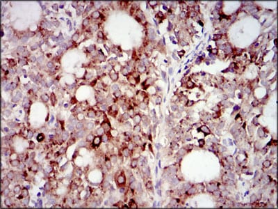 Figure 5: Immunohistochemical analysis of paraffin-embedded cervical cancer tissues using PIK3R1 mouse mAb with DAB staining.