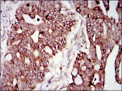 Figure 6: Immunohistochemical analysis of paraffin-embedded rectum cancer tissues using PIK3R1 mouse mAb with DAB staining.