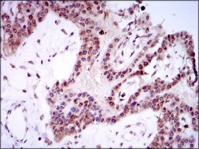 Figure 5: Immunohistochemical analysis of paraffin-embedded ovarian cancer tissues using SPIB mouse mAb with DAB staining.