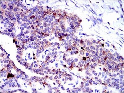 Figure 2: Immunohistochemical analysis of paraffin-embedded ovarian cancer tissues using ANXA1 mouse mAb with DAB staining.