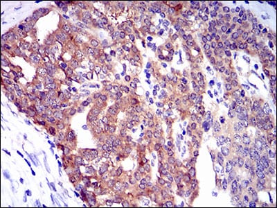 Figure 2: Immunohistochemical analysis of paraffin-embedded ovarian cancer tissues using TWF1 mouse mAb with DAB staining.