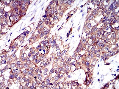 Figure 2: Immunohistochemical analysis of paraffin-embedded bladder cancer tissues using TWF1 mouse mAb with DAB staining.