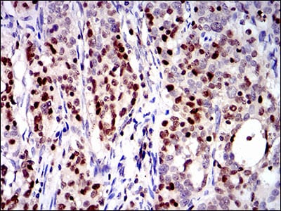 Figure 5: Immunohistochemical analysis of paraffin-embedded cervical cancer tissues using RUNX3 mouse mAb with DAB staining.