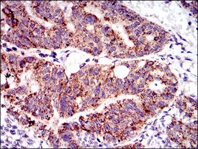 Figure 5: Immunohistochemical analysis of paraffin-embedded rectum cancer tissues using PTPN11 mouse mAb with DAB staining.