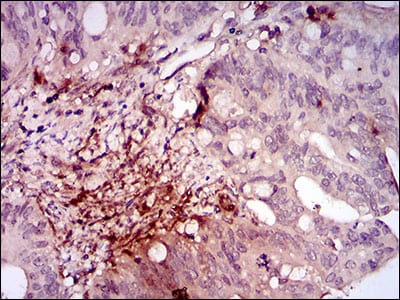 Figure 5: Immunohistochemical analysis of paraffin-embedded rectum cancer tissues using ILK mouse mAb with DAB staining.