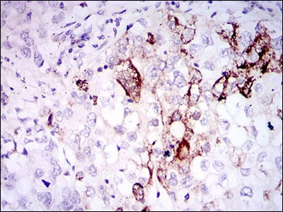 Figure 4: Immunohistochemical analysis of paraffin-embedded lung cancer tissues using SST mouse mAb with DAB staining.