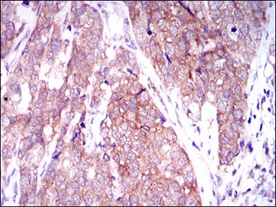 Figure 4: Immunohistochemical analysis of paraffin-embedded bladder cancer tissues using MARK3 mouse mAb with DAB staining.