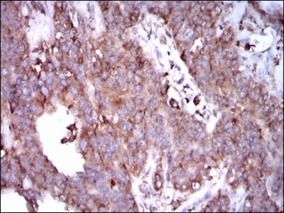 Figure 5: Immunohistochemical analysis of paraffin-embedded ovarian cancer tissues using STAT5A mouse mAb with DAB staining.