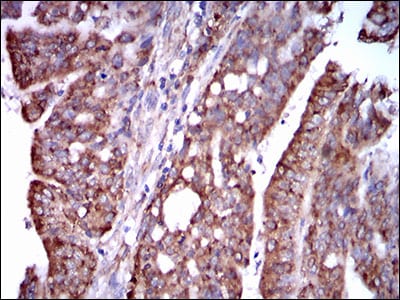 Figure 6: Immunohistochemical analysis of paraffin-embedded rectum cancer tissues using STAT5A mouse mAb with DAB staining.