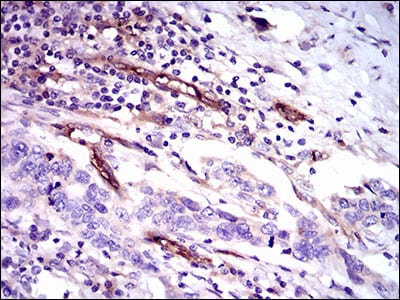 Figure 7: Immunohistochemical analysis of paraffin-embedded esophageal cancer tissues using CD59 mouse mAb with DAB staining.