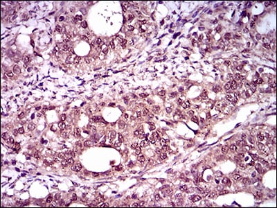 Figure 5: Immunohistochemical analysis of paraffin-embedded cervical cancer tissues using T mouse mAb with DAB staining.